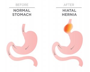 Hiatal Hernia