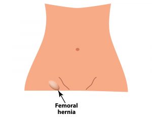 femoral hernia