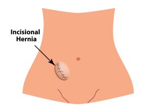 incisional hernia