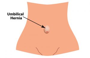 umbilical hernia