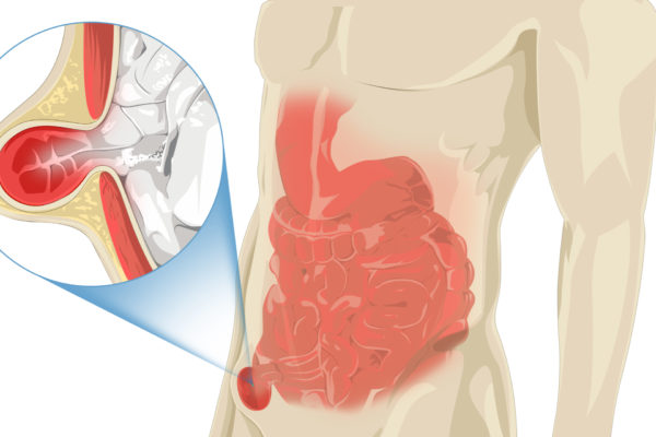Human Illustration with Stomach Pain, Zoom-in inguinal hernia
